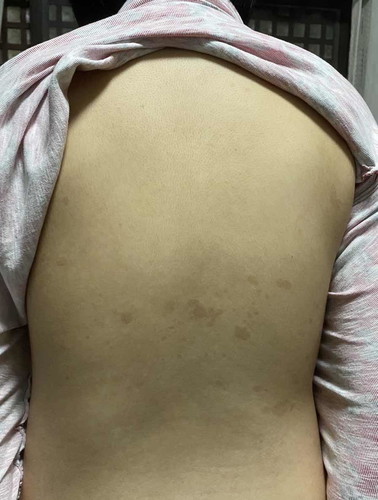 Dark patches sa likod