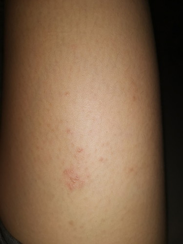 Rashes