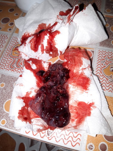 ปวดสุดๆหลุดแล้วจริงๆ  8w1d?