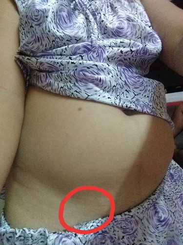 ถามหน่อยค่ะมีใครเคยเจ็บใต้ท้องน้อยมั้งเจ็บแบบแป๊บขึ้นมาแล้วหายไปพักนึงแล้วเจ็บใหม่แบบนานครั้งแต่ไม่มีเลือดออกนะตรงที่วงกลมไว้ค่ะใช่ปีกมดลูกป่าวค่ะ