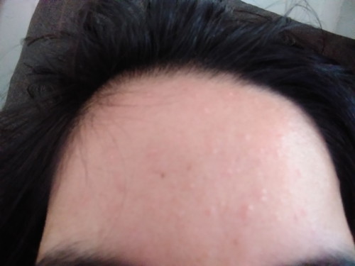 parang pimples