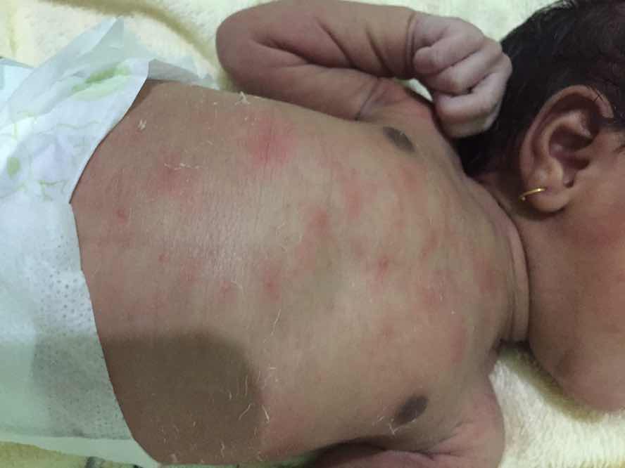 Kulit newborn kemerahan