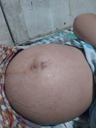 ท้องเป็นผื่นแดง และคัน