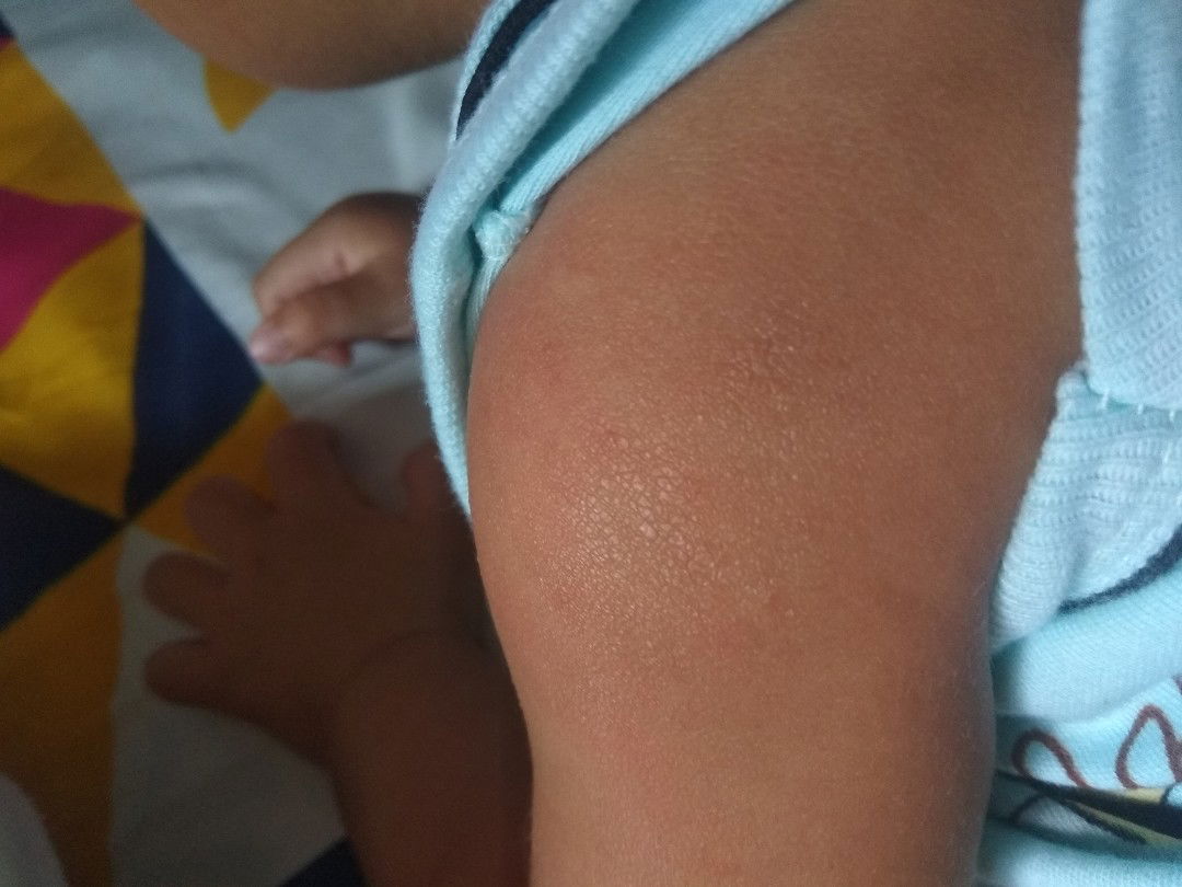 Kulit kering dan gatal2