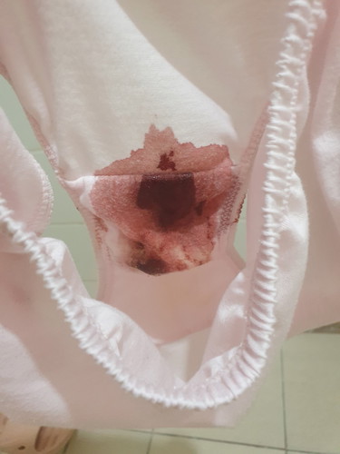 6 weeks pregnant then had spotting/ bleeding