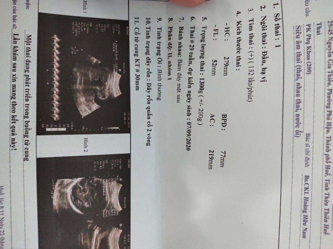 dây rốn quấn cổ 2 vòng