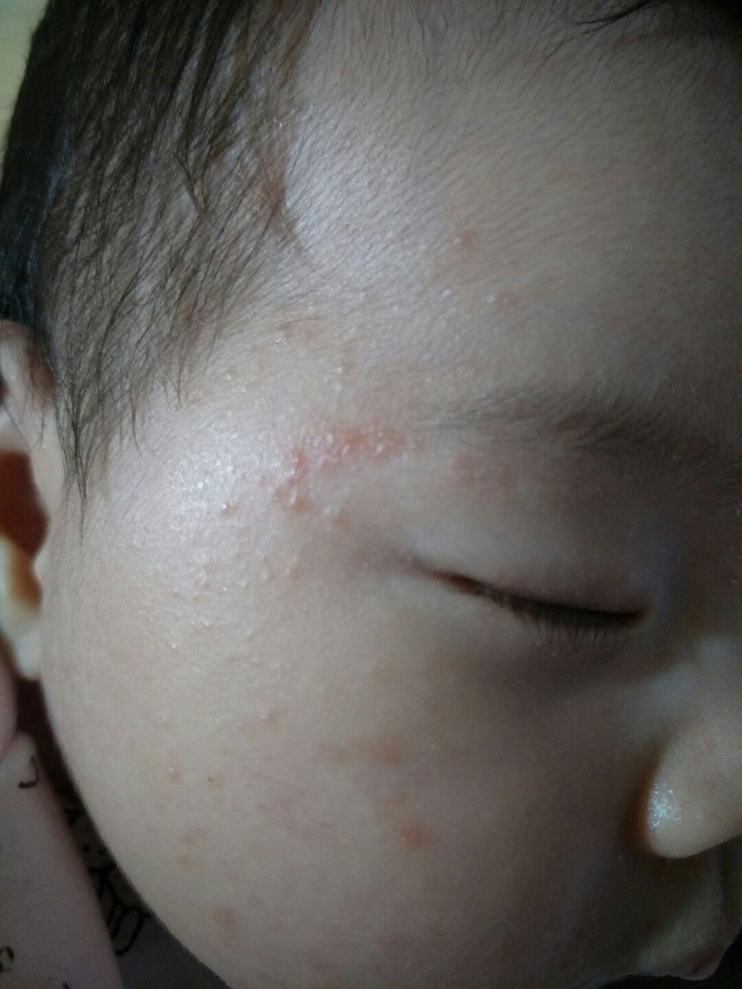 Chàm sữa ở trẻ