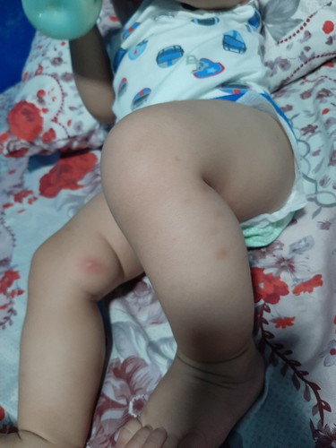insect Bites