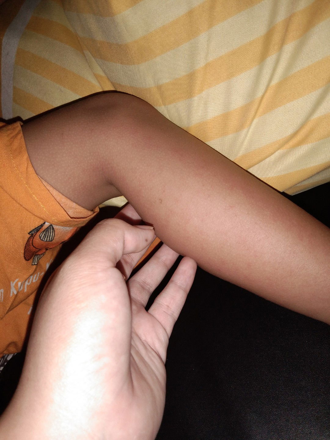 bintik merah pada anak