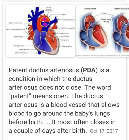Patent Ductus Arteriosus (PDA)