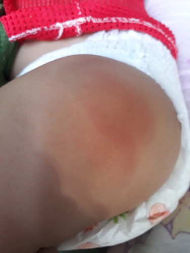 น้องหมอนัดฉีดยาพอกลับมาแล้วบวมแดงแบบนี้ปัยรัยมัยคร๊