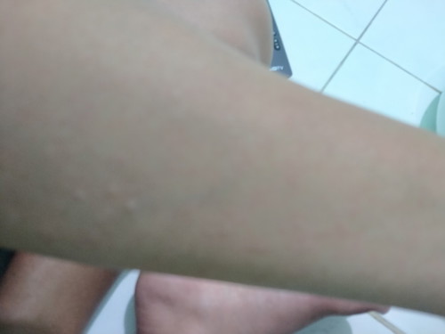 มีคุณแม่บ้านไหนเป็นผื่นคันไหมค่ะ