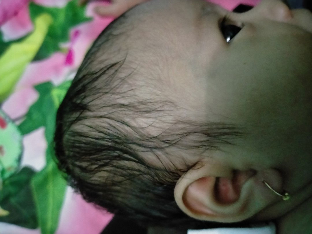 Bekas tindikan anting