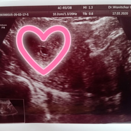 ภาวะแท้งคุกคาม