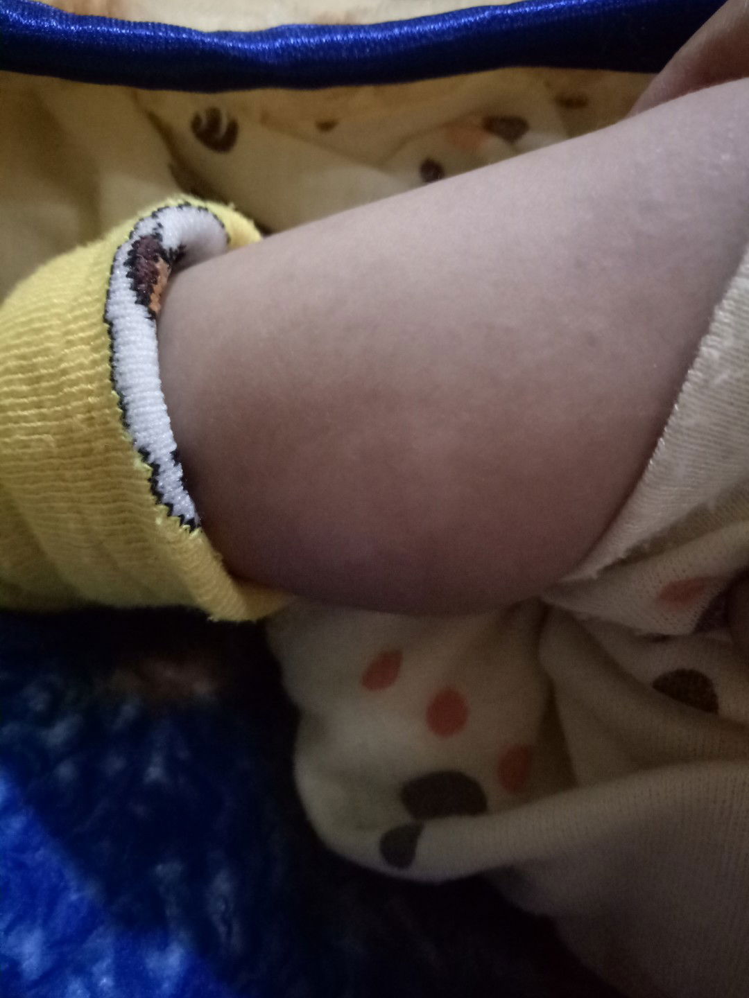 bercak putih pada kulit bayi 1bulan 21 hari