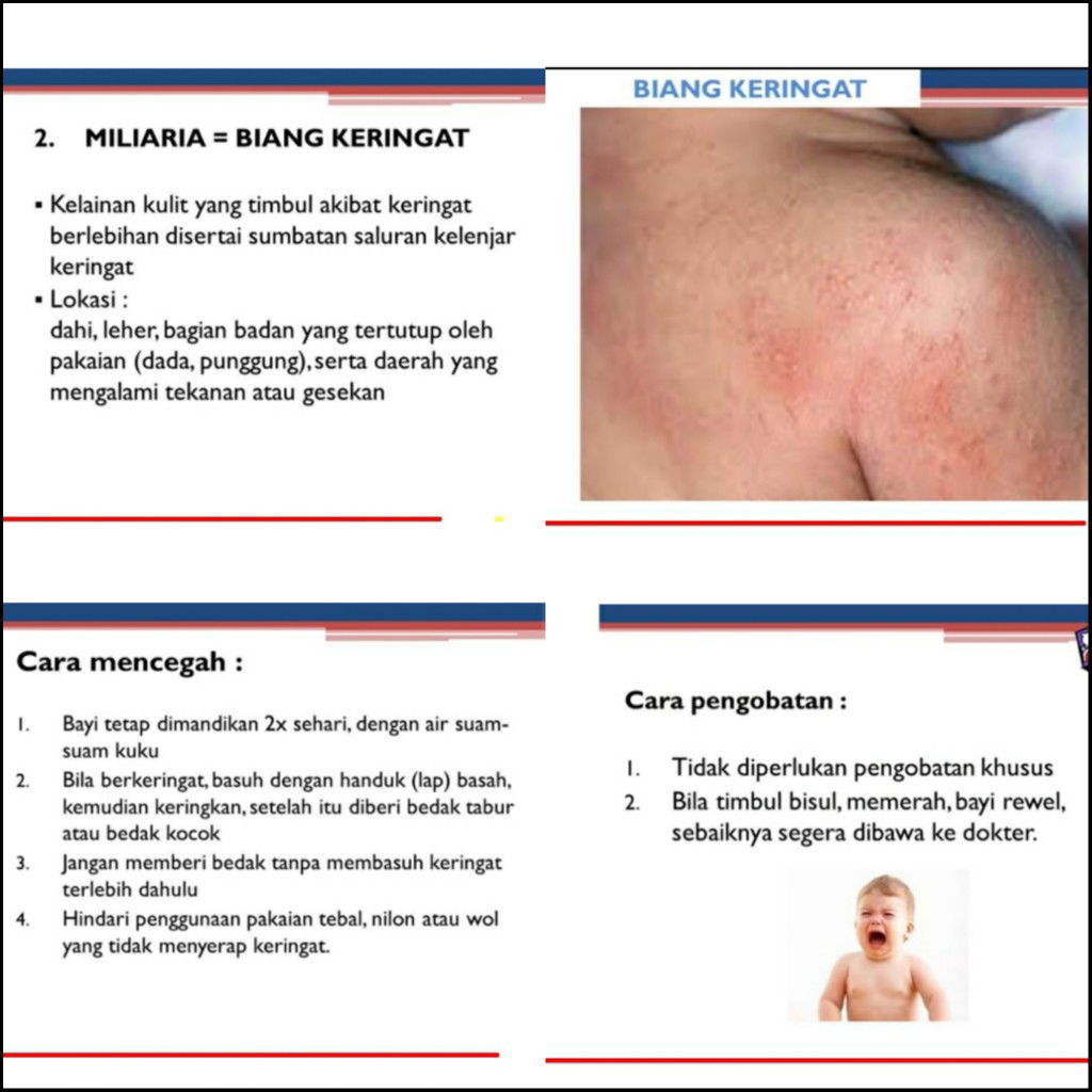 Sharing penjelasan dokter kulit [ apa itu miliaria/biang keringat & gimana mencegahnya?] Part 4