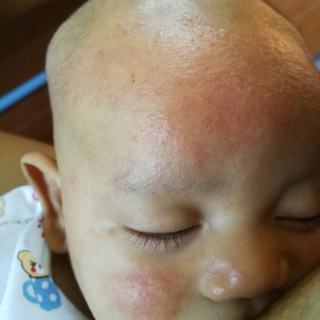 น้องผิวหนังอักเสบ