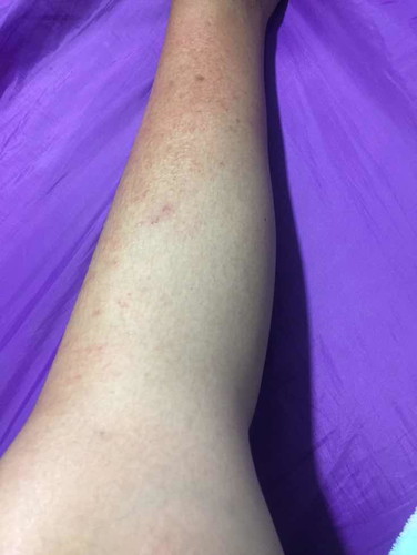 ขึ้นผื่นแดงแบบนี้อันตรายต่อเด็กในท้องไหมค่ะ