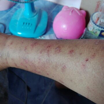 ผดผื่นคัน