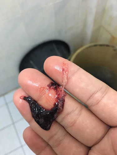 เเบบนี้คือมูกเลือดใช่ไหมค่ะ ออกมาพร้อมฉี่ไม่มีอาการอื่นร่วมต้องไปรพเลยไหมหรือต้องรอเจ็บท้องด้วย37+5w