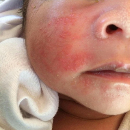 Rashes?