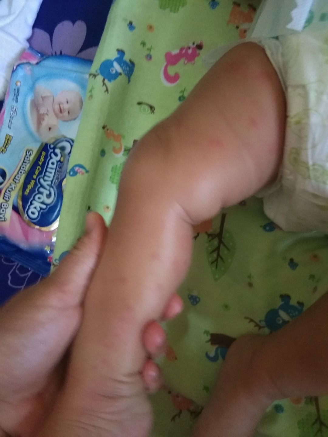 bintik-bintik merah di tangan dan kaki bayi
