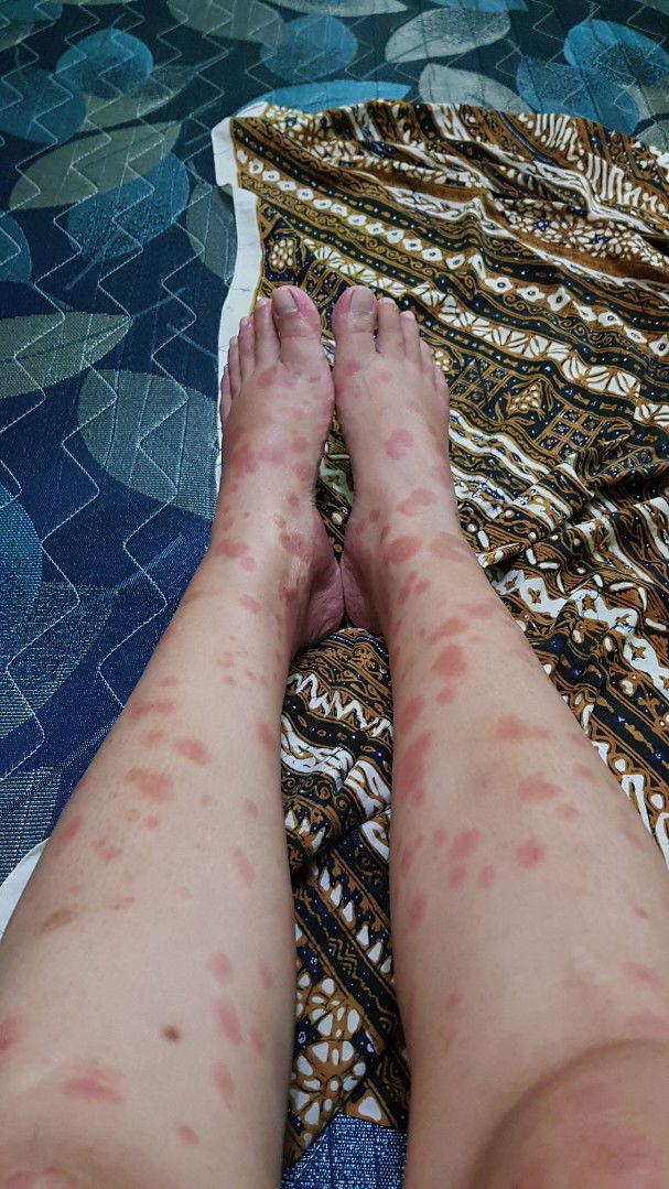 muncul ruam kemerahan & gatal di seluruh tubuh