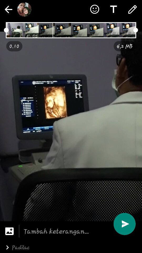 USG Minggu ke 16 Hari ke 6