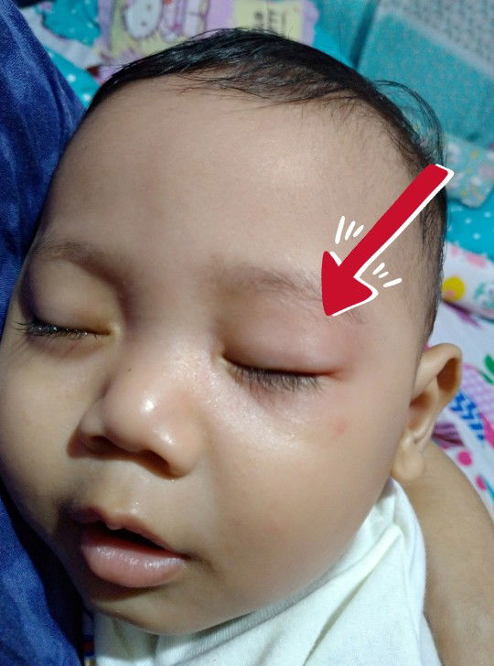 Mata Bayik Digigit Semut