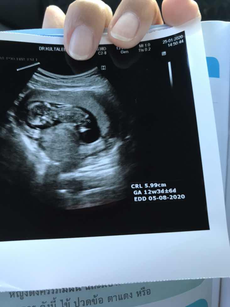 วินาทีที่คุณพ่อคุณแม่ได้ยินเสียงหัวใจลูก❤️