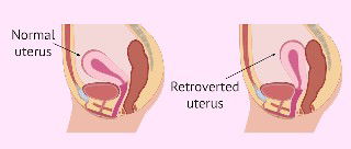 Retroverted uterus