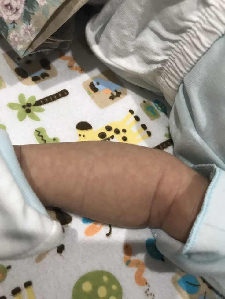 kulit bayi bercak2, tidak sama warnanya