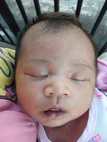 น้องเเตกผื่น