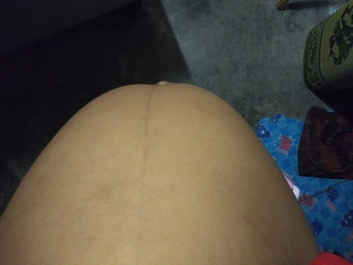 33w6d