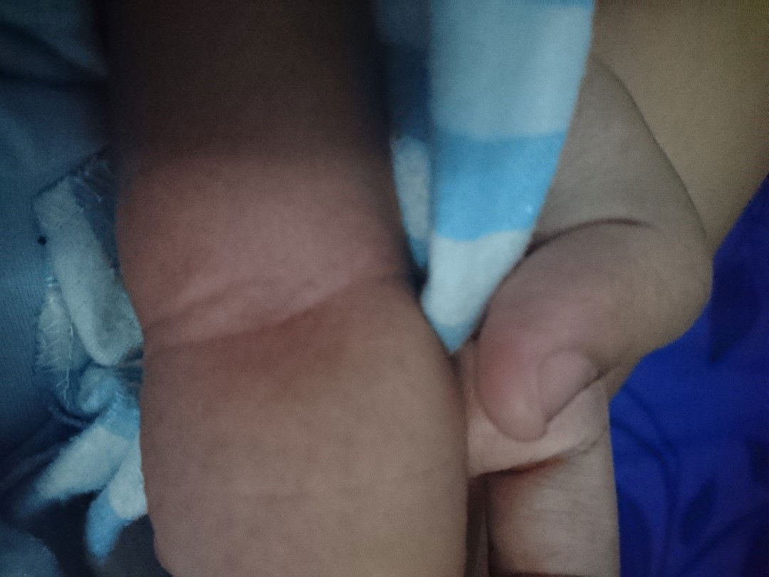 bintik merah pada kulit bayi