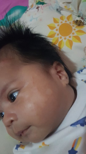 ruam susu