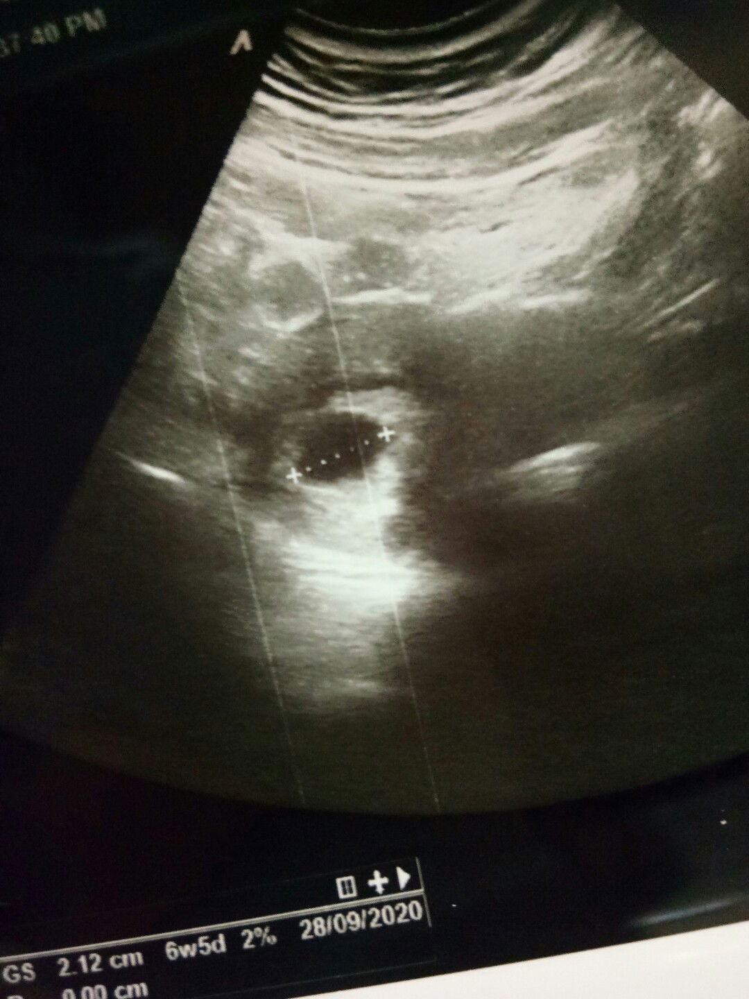 Hamil berapa minggu kelihatan ada embrionya?