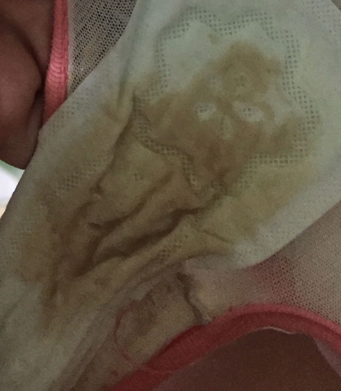 มีเลือดออกแต่เป็นสีน้ำตาลอ่อนๆอายุครรภ์8w7d