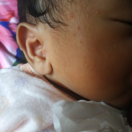 kulit bayi bintik merah