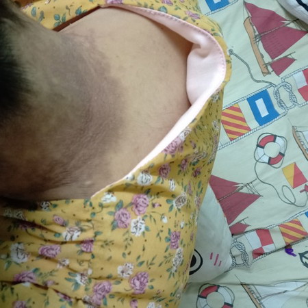 คอดำแตกเป็นแผ่นๆๆ