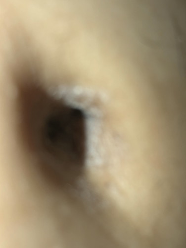 Belly button DRYNESS during pregnancy.