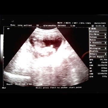 Hasil Hpht Beda Dengan Hasil Usg..