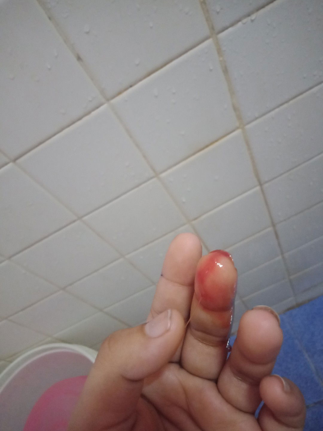 เลือดออกทางช่องคลอดระหว่างตั้งครรภ์