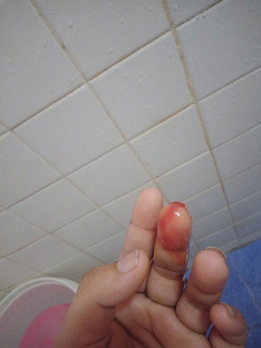 เลือดออกทางช่องคลอดระหว่างตั้งครรภ์