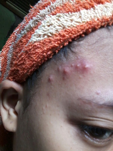 pimples?