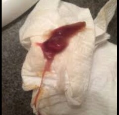 mucus plug