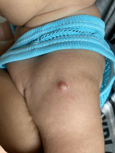 ลูกปลูกฝีเป็นหนอง