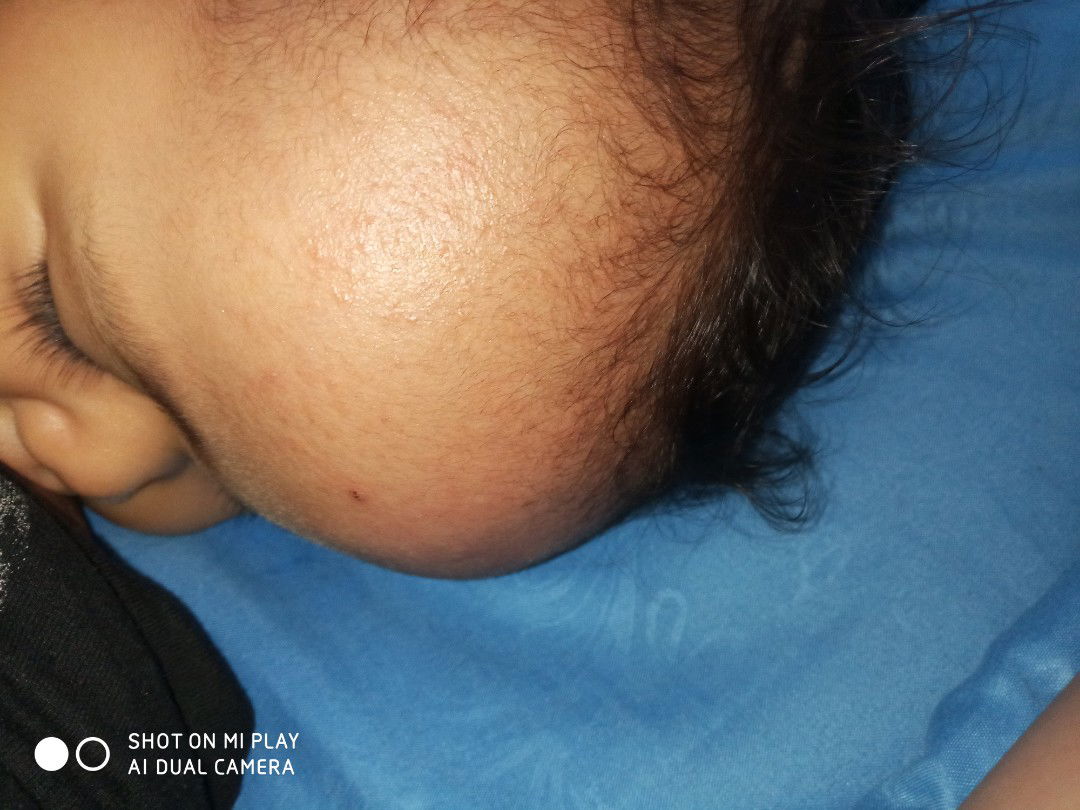 obat untuk bianh keringat