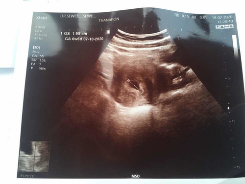 อัลตราซาวด์