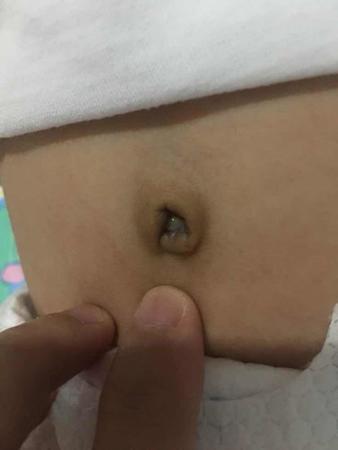Umbilical cord